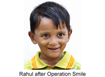 Rahul after Operation Smile, Alium Partners' chosen charity. 